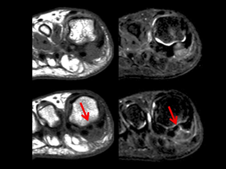 Figure 2 for case calcium hydroxyapatite crystal deposition disease ( RID3594 )
